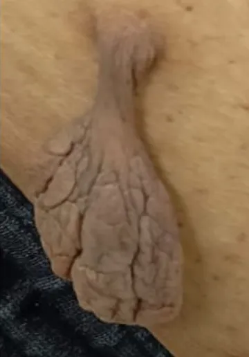 Mole Removal Before and after results at Dermatrix Clinic