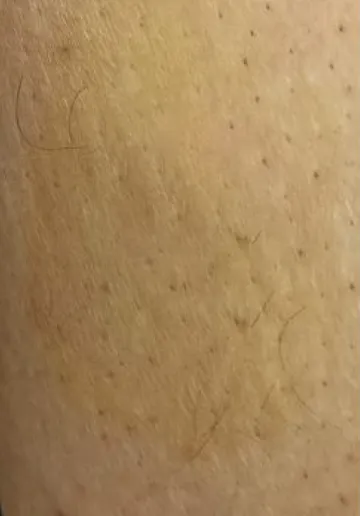 Mole Removal Before and after results at Dermatrix Clinic