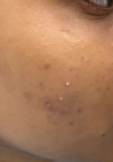 Chemical Peel Before and after results at Dermatrix Clinic