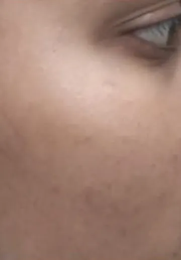 Chemical Peel Before and after results at Dermatrix Clinic