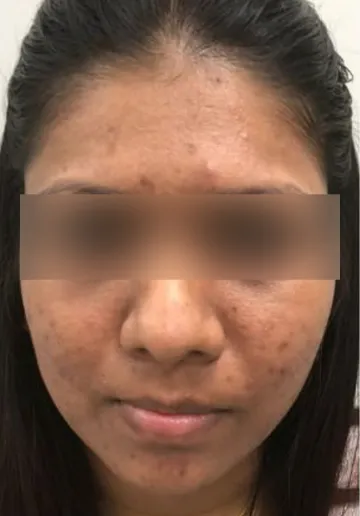 Chemical Peel Before and after results at Dermatrix Clinic