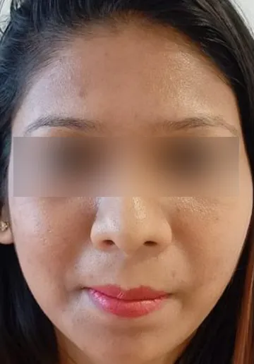 Chemical Peel Before and after results at Dermatrix Clinic