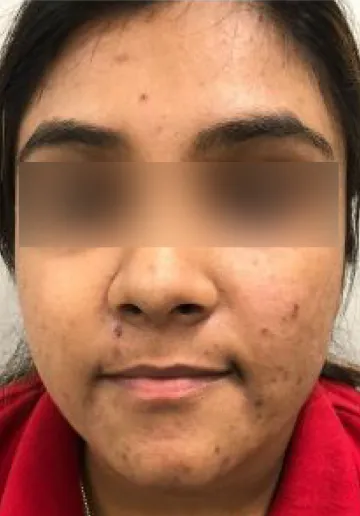 Chemical Peel Before and after results at Dermatrix Clinic
