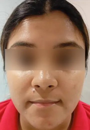 Chemical Peel Before and after results at Dermatrix Clinic