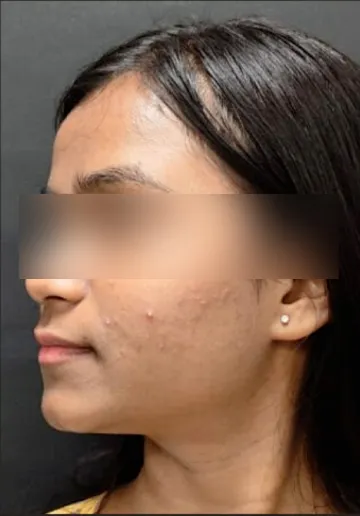 Chemical Peel Before and after results at Dermatrix Clinic