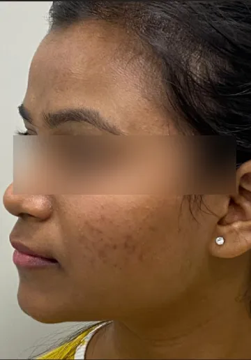 Chemical Peel Before and after results at Dermatrix Clinic