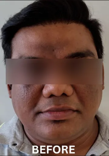 Chemical Peel Before and after results at Dermatrix Clinic