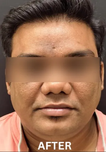 Chemical Peel Before and after results at Dermatrix Clinic