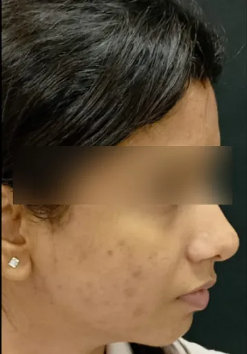 Chemical Peel Before and after results at Dermatrix Clinic