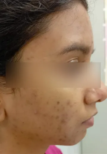 Chemical Peel Before and after results at Dermatrix Clinic