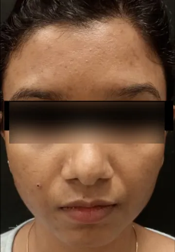 Chemical Peel Before and after results at Dermatrix Clinic