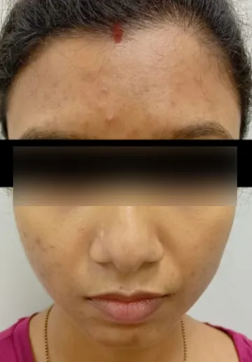 Chemical Peel Before and after results at Dermatrix Clinic