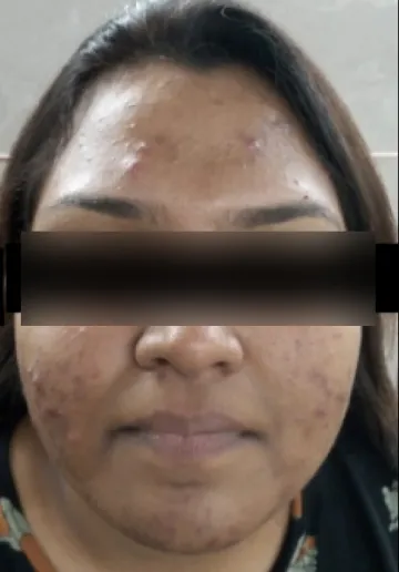 Chemical Peel Before and after results at Dermatrix Clinic