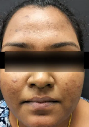 Chemical Peel Before and after results at Dermatrix Clinic