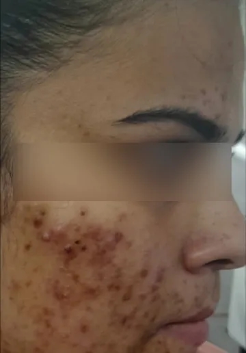 Acne Treatment Before and after results at Dermatrix Clinic