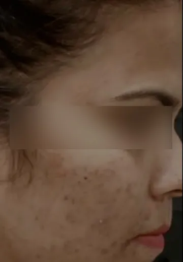 Acne Treatment Before and after results at Dermatrix Clinic