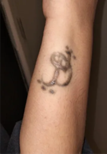Tattoo Removal Before and after results at Dermatrix Clinic