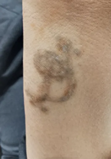 Tattoo Removal Before and after results at Dermatrix Clinic