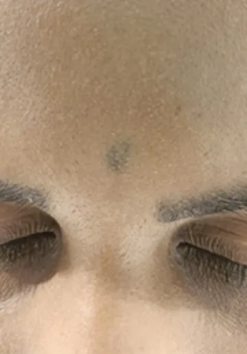 Tattoo Removal Before and after results at Dermatrix Clinic