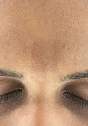 Tattoo Removal Before and after results at Dermatrix Clinic