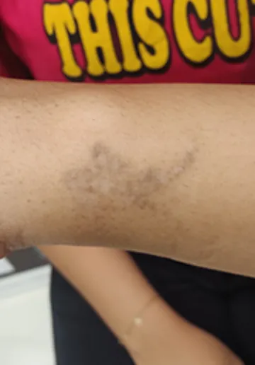 Tattoo Removal Before and after results at Dermatrix Clinic