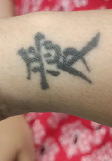 Tattoo Removal Before and after results at Dermatrix Clinic