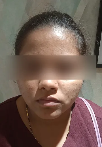 Acne Treatment Before and after results at Dermatrix Clinic