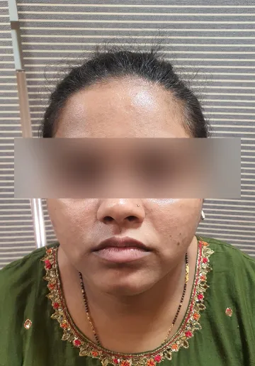 Acne Treatment Before and after results at Dermatrix Clinic