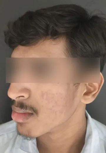 Chemical Peel Before and after results at Dermatrix Clinic