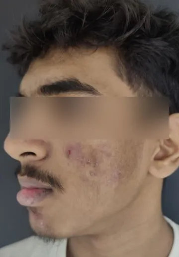 Chemical Peel Before and after results at Dermatrix Clinic
