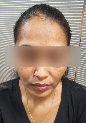 Chemical Peel Before and after results at Dermatrix Clinic