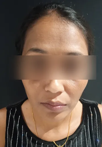 Chemical Peel Before and after results at Dermatrix Clinic