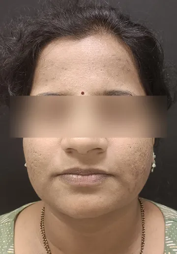Chemical Peel Before and after results at Dermatrix Clinic