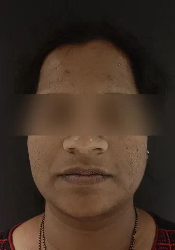 Chemical Peel Before and after results at Dermatrix Clinic