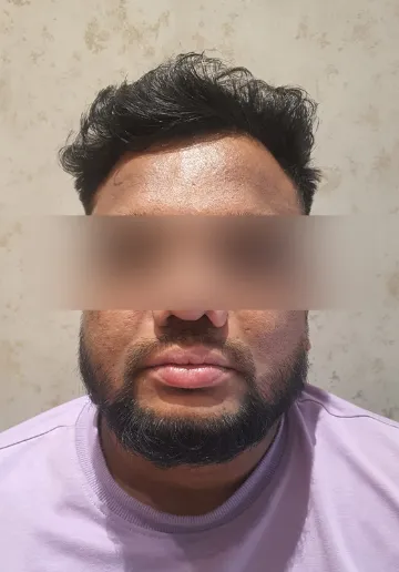 Chemical Peel Before and after results at Dermatrix Clinic