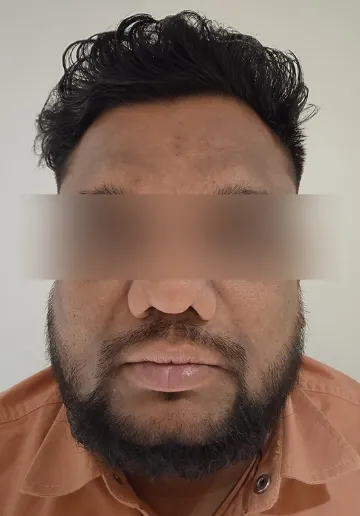 Chemical Peel Before and after results at Dermatrix Clinic