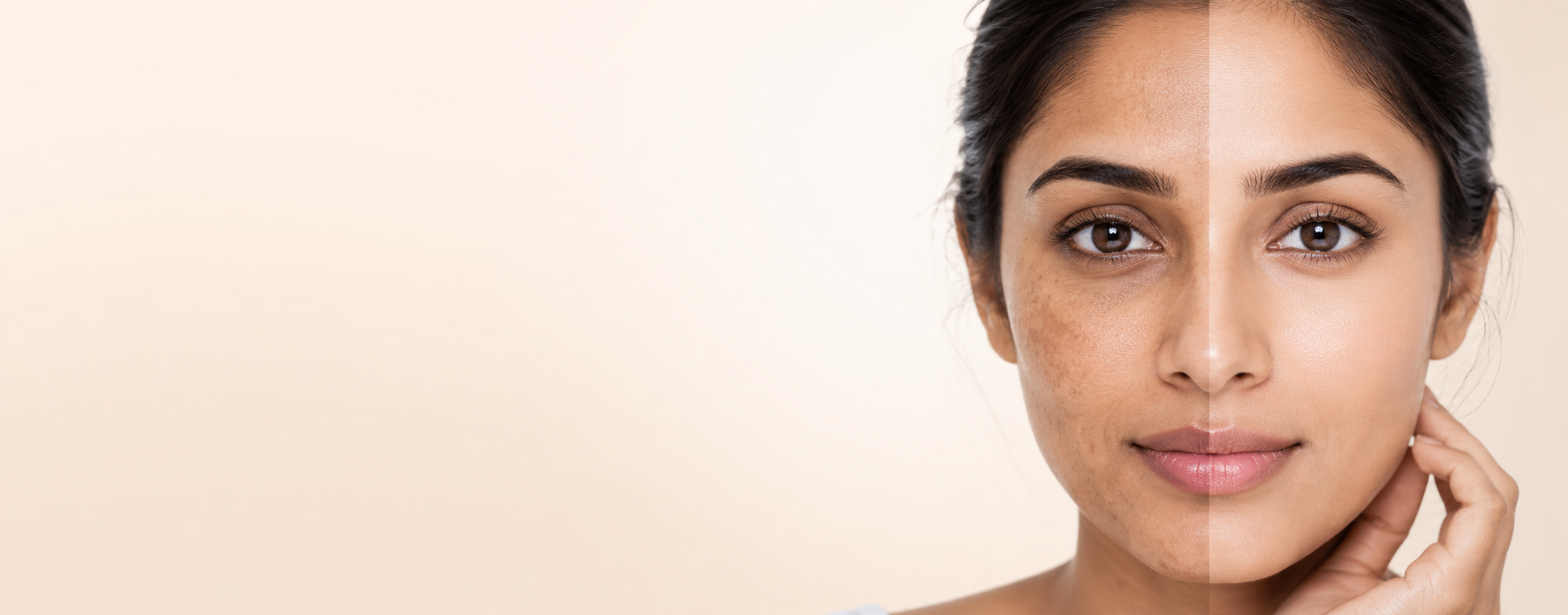 Q Laser Treatment for Pigmentation in Thane