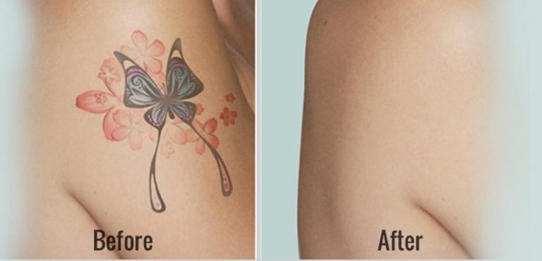 Permanent Tattoo Removal, Tattoo Removal In Kalwa, Thane - View Cost, Book  Appointment Online | Practo