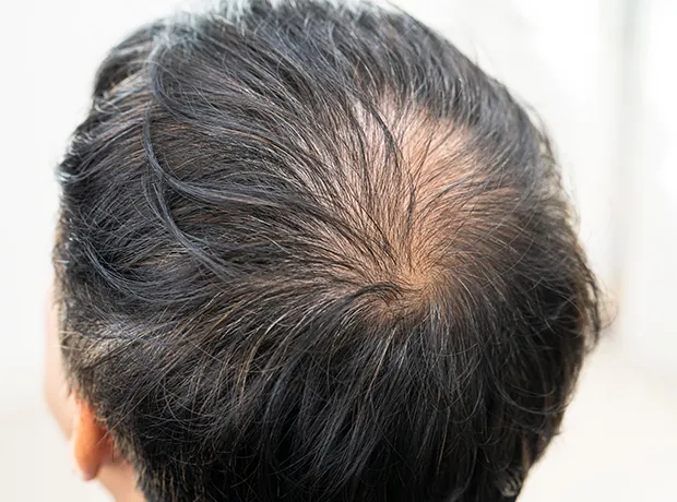 Top view of a person with visible hair thinning on the crown of the head 620x460
